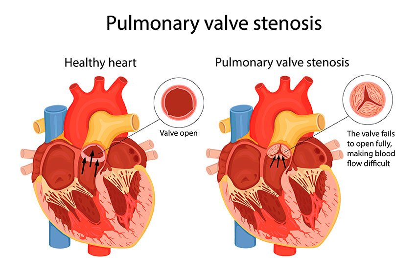 Síntomas de estenosis pulmonar
