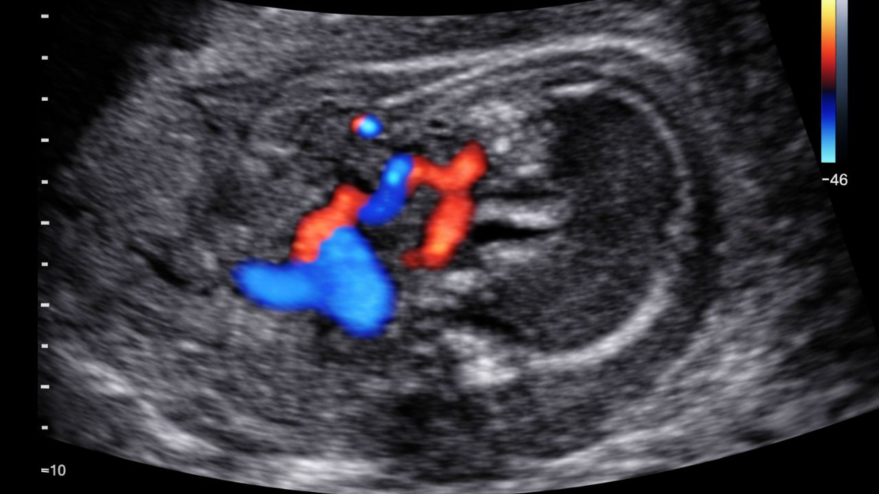 ARSA fetal